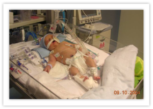 Baby Dalton, awaiting surgery for unicuspid aortic stenosis